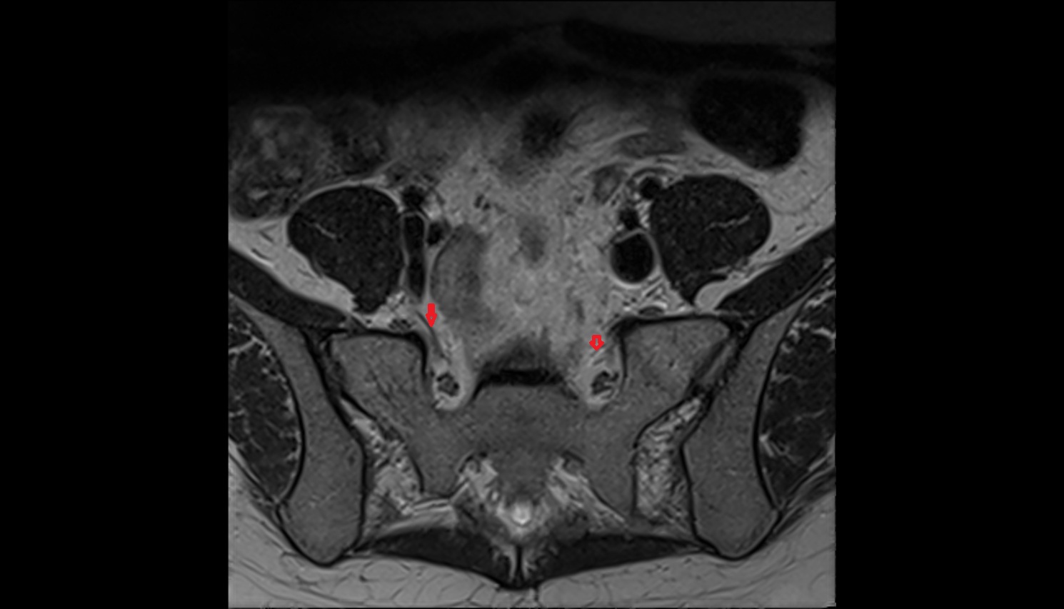 Lateral sacral artery mri axial