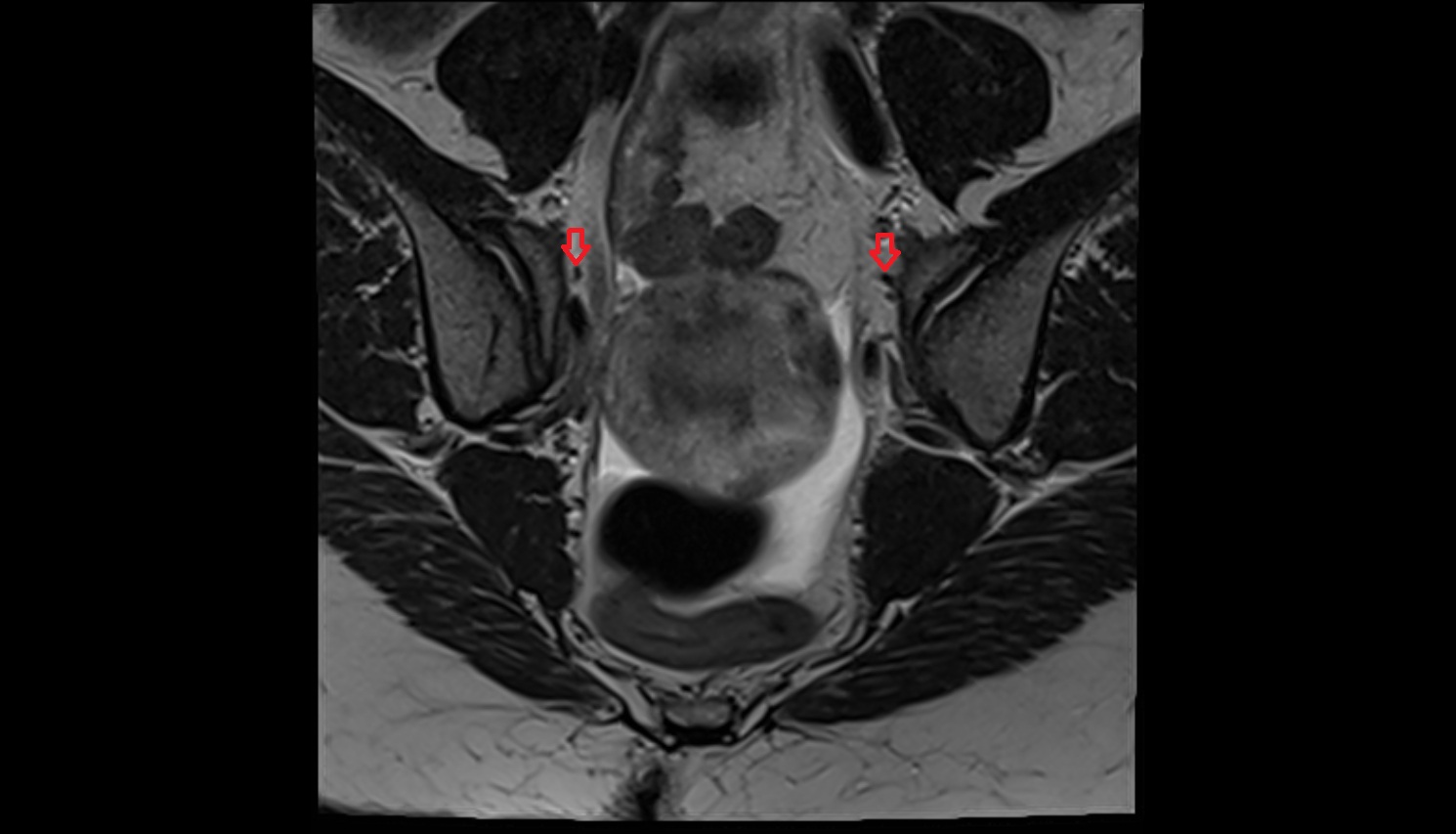 Lateral sacral artery  mri coronal  anatomy  image-img-00000-00000