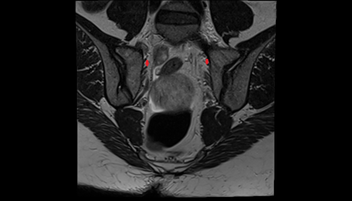 Lateral sacral artery  mri coronal  anatomy  image-img-00000-00000_00001