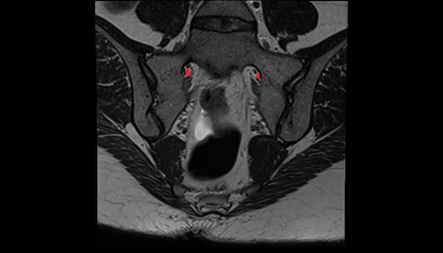 Lateral sacral artery  mri coronal  anatomy  image-img-00000-00000_00002