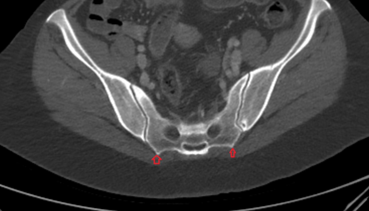 Lateral sacral crest CT AXIAL anatomy  image-img-00000-00000