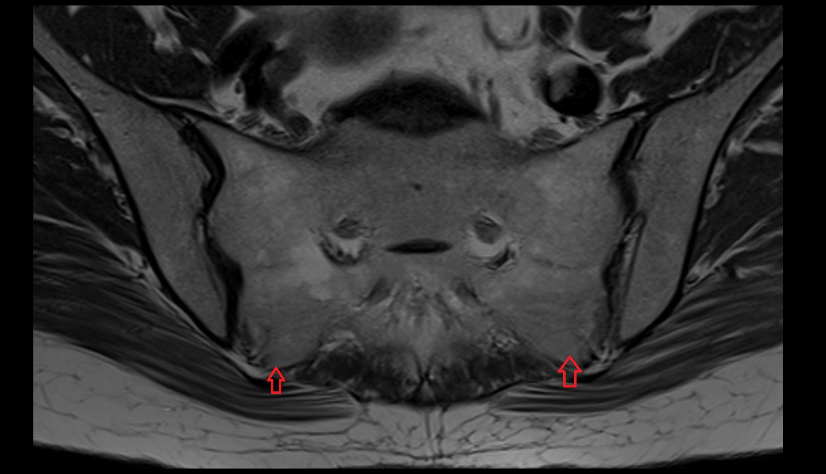 Lateral sacral crest MRI axial image