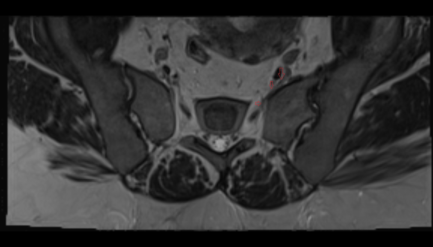 Lateral sacral vein  mri axial  anatomy  image-img-00000-00000