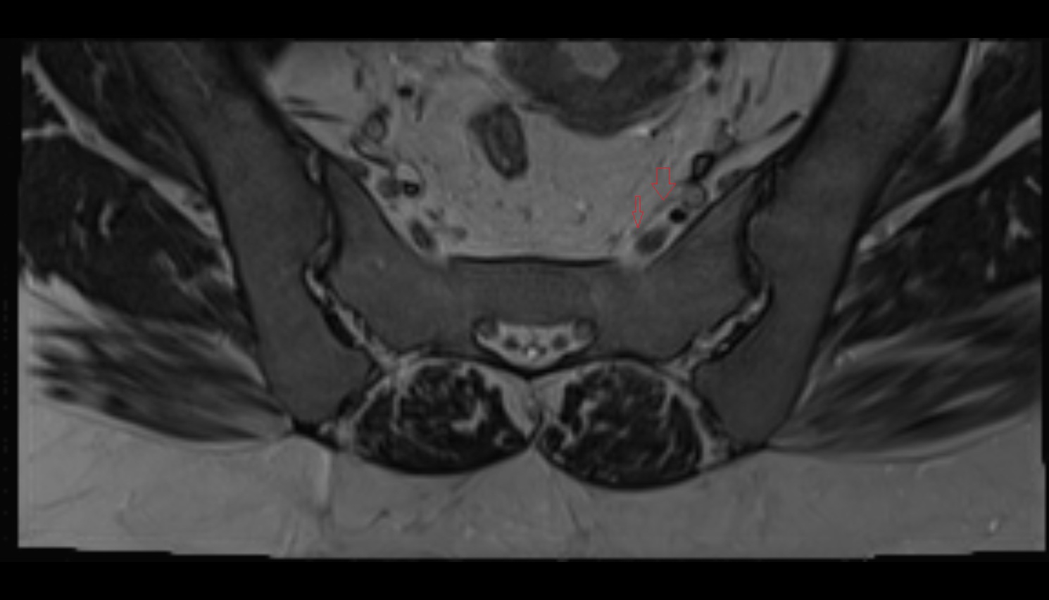 Lateral sacral vein  mri axial  anatomy  image-img-00000-00000_00001