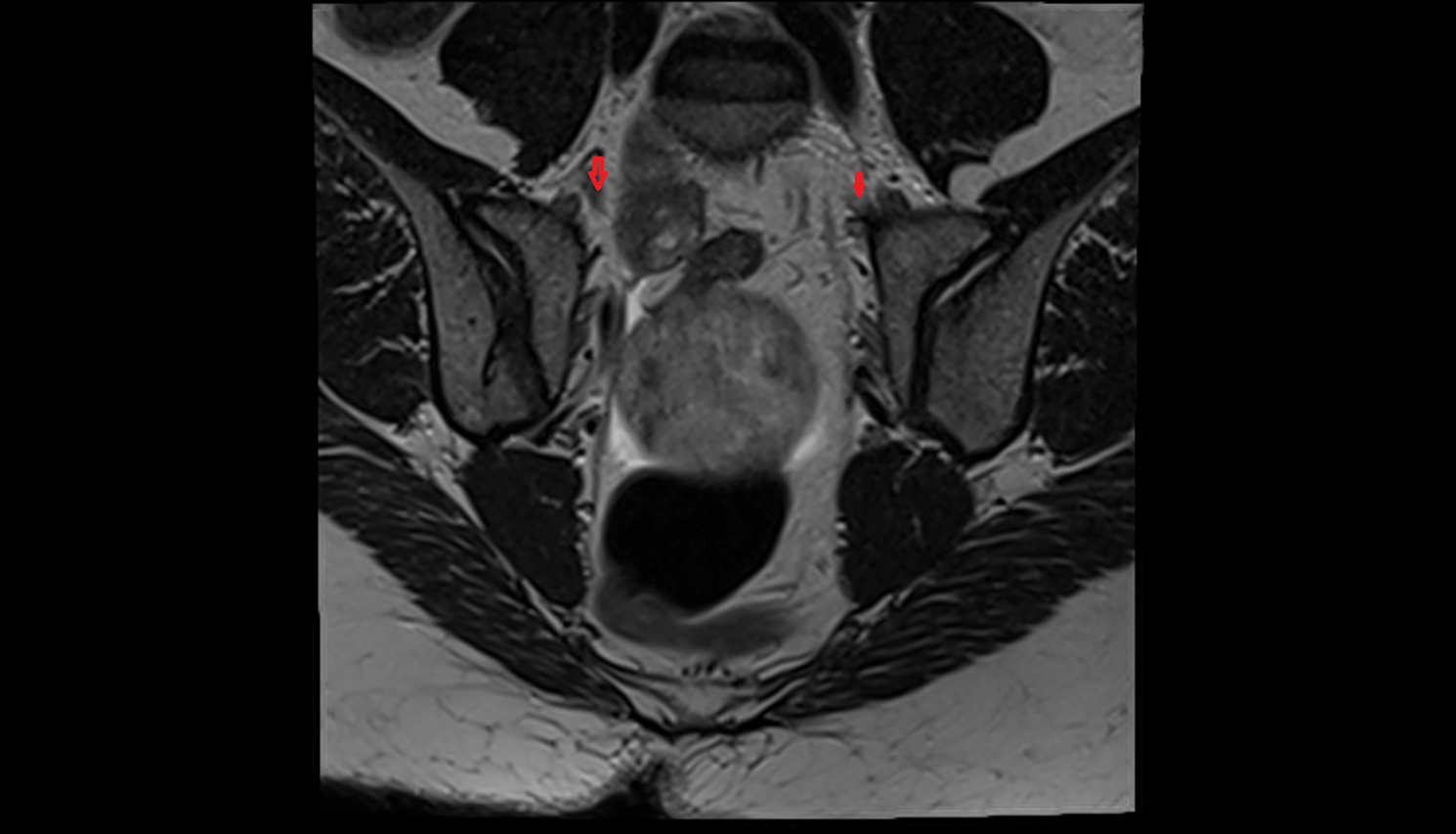 Lateral sacral vein mri coronal  anatomy  image-img-00000-00000