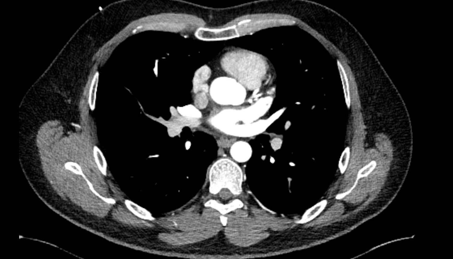 Lateral segmental artery of right lung  anatomy CT axial  image -img-00000-00000