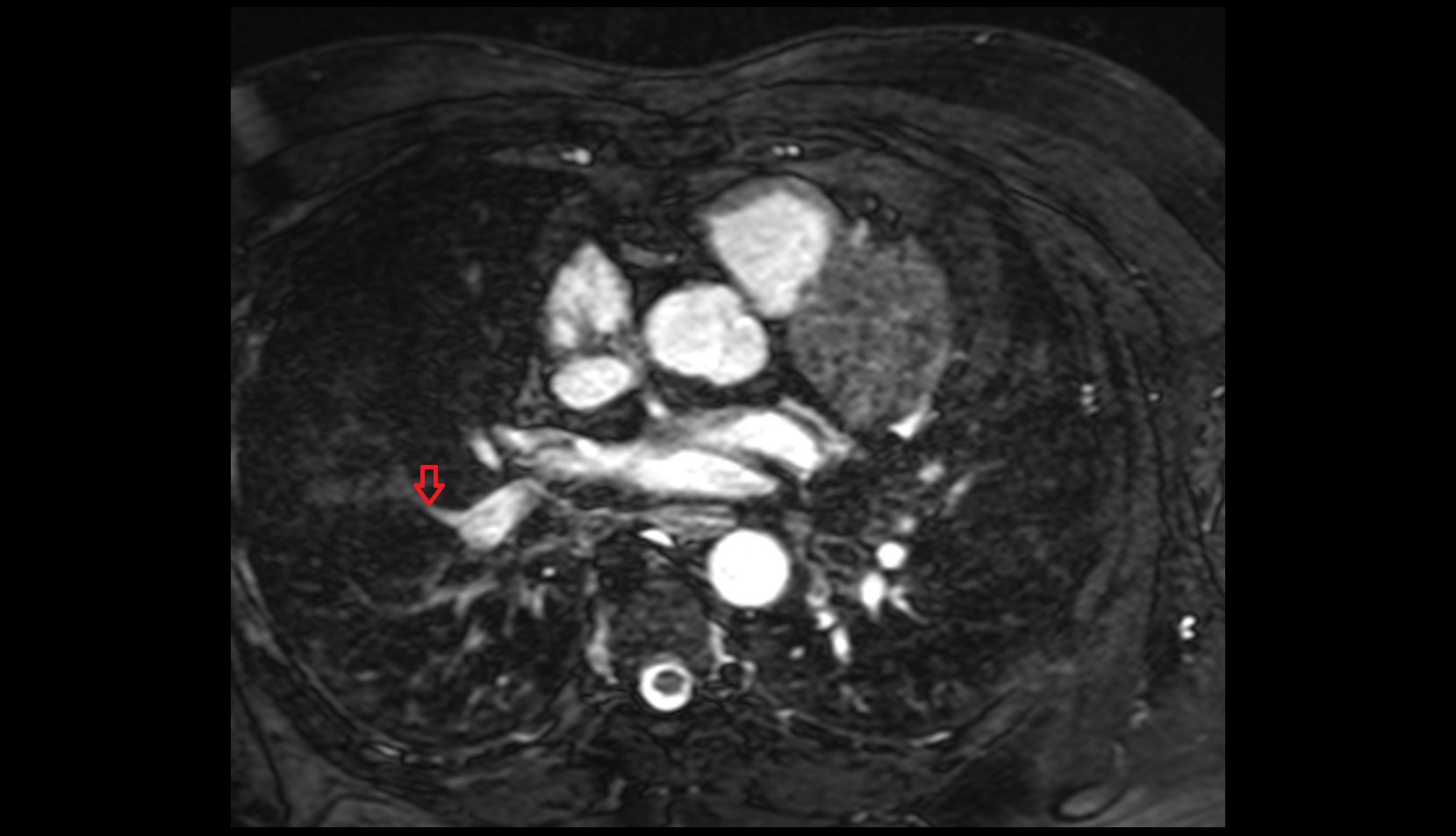 Lateral segmental artery of right lung mri image