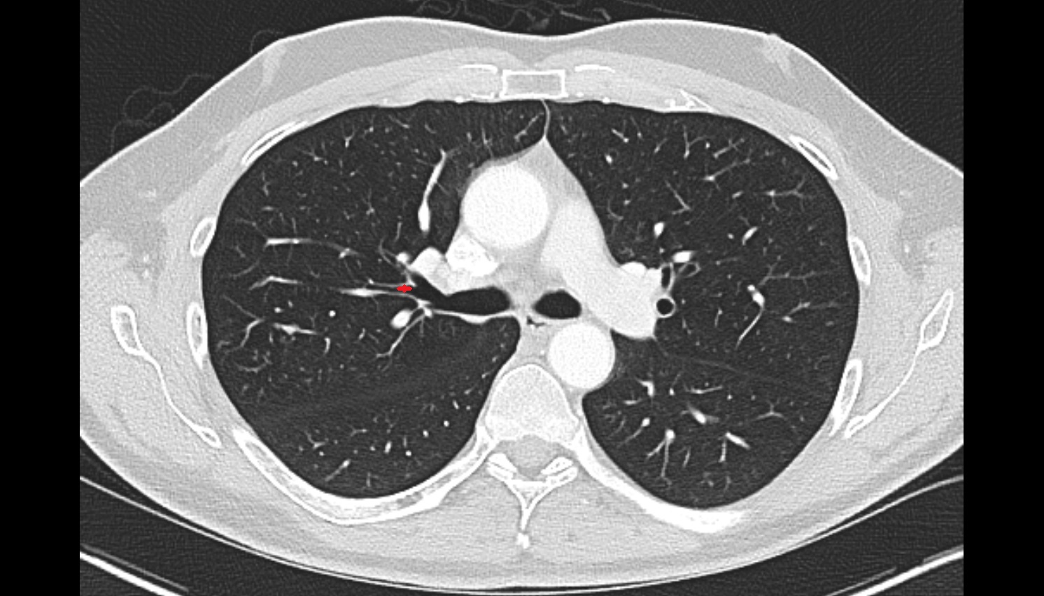 Lateral segmental bronchus of right lung   CT axial image -img-00000-00000
