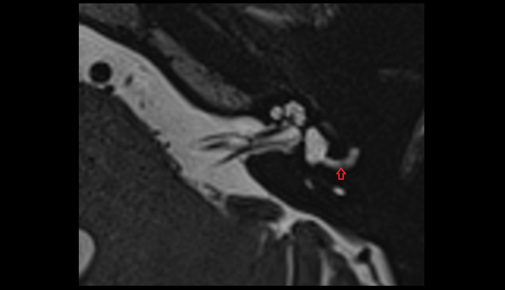 Lateral semicircular canal mri axial image 1