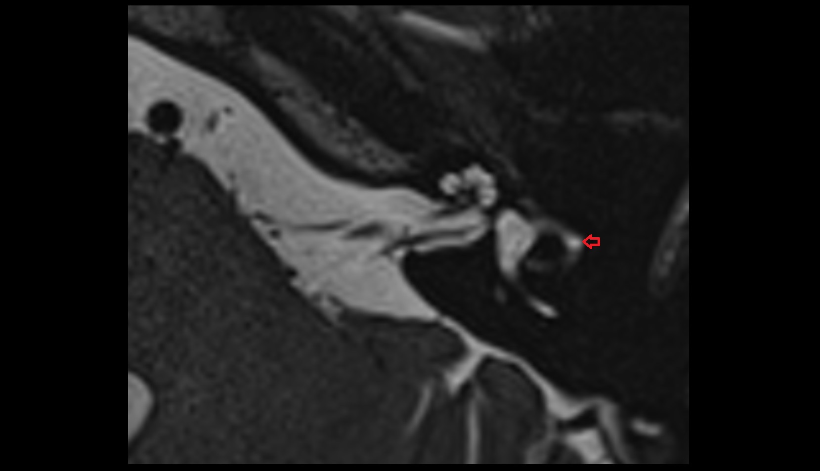 Lateral semicircular canal mri axial image 2