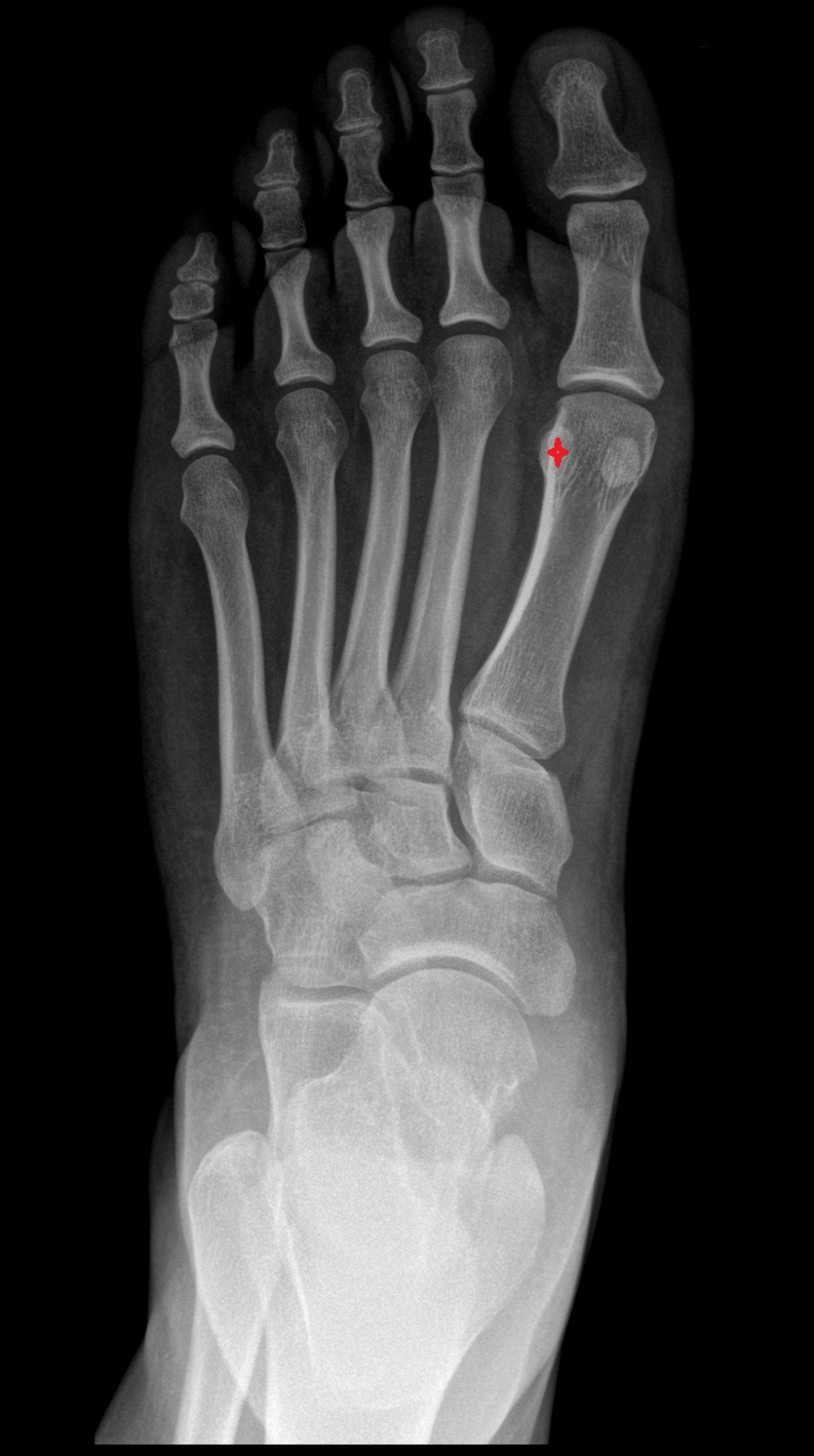 Lateral sesamoid bone