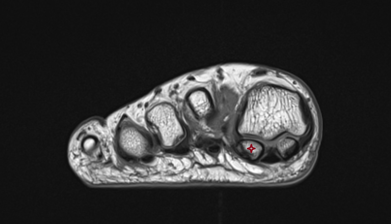 Medial sesamoid bone  mri  anatomy labelled image-img-00000-00000