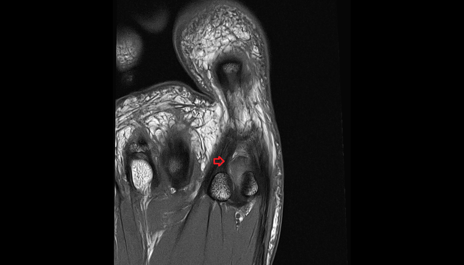 Lateral sesamoid phalangeal ligament of foot  coronal cross sectional anatomy 3T MRI AI enhanced radiology image-img-00000-00000