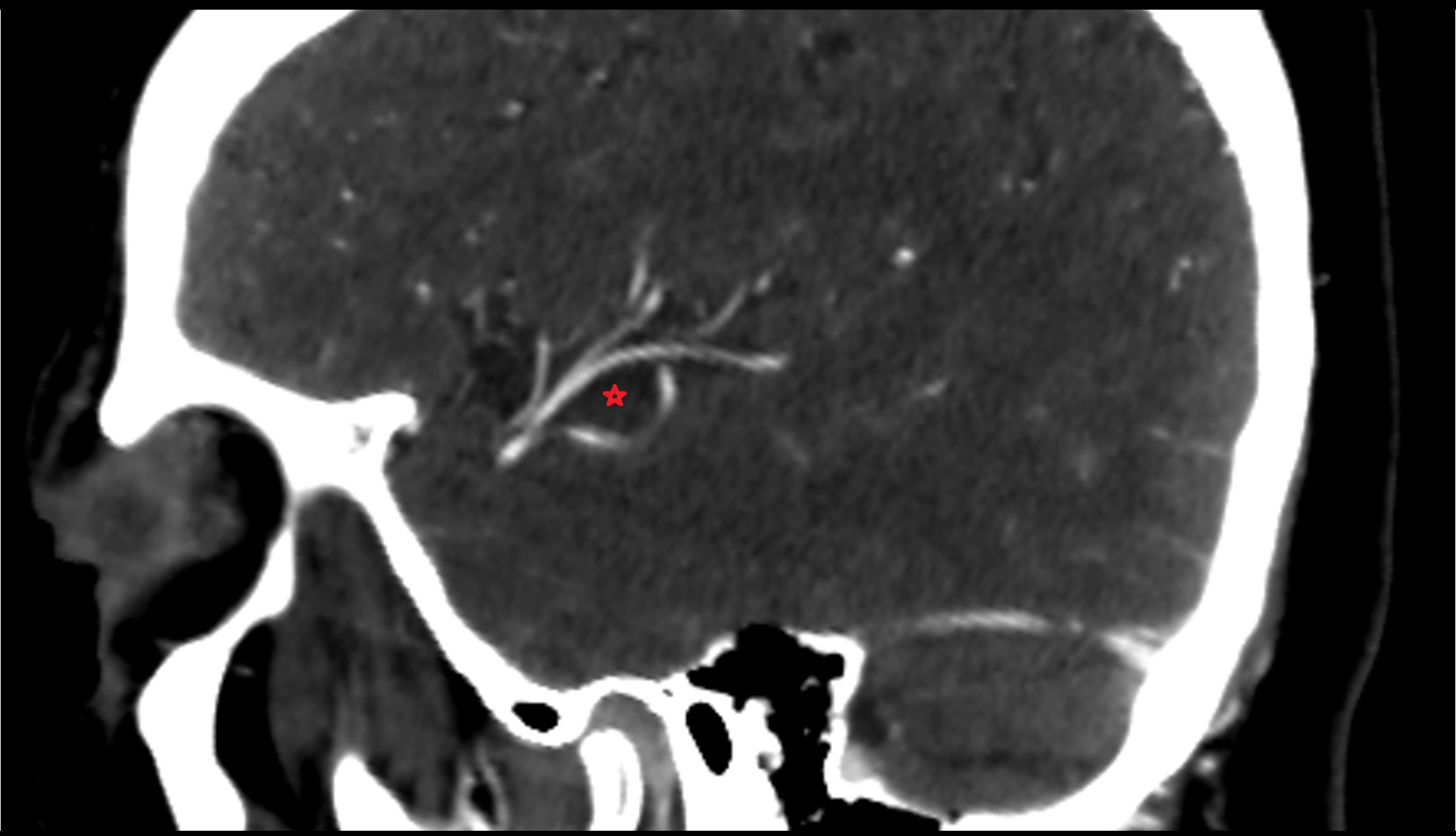 Lateral sulcus (Sylvian fissure) CT IMAGE