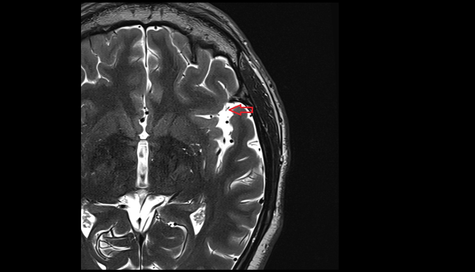 Lateral sulcus (Sylvian fissure) MRI 3T axial image