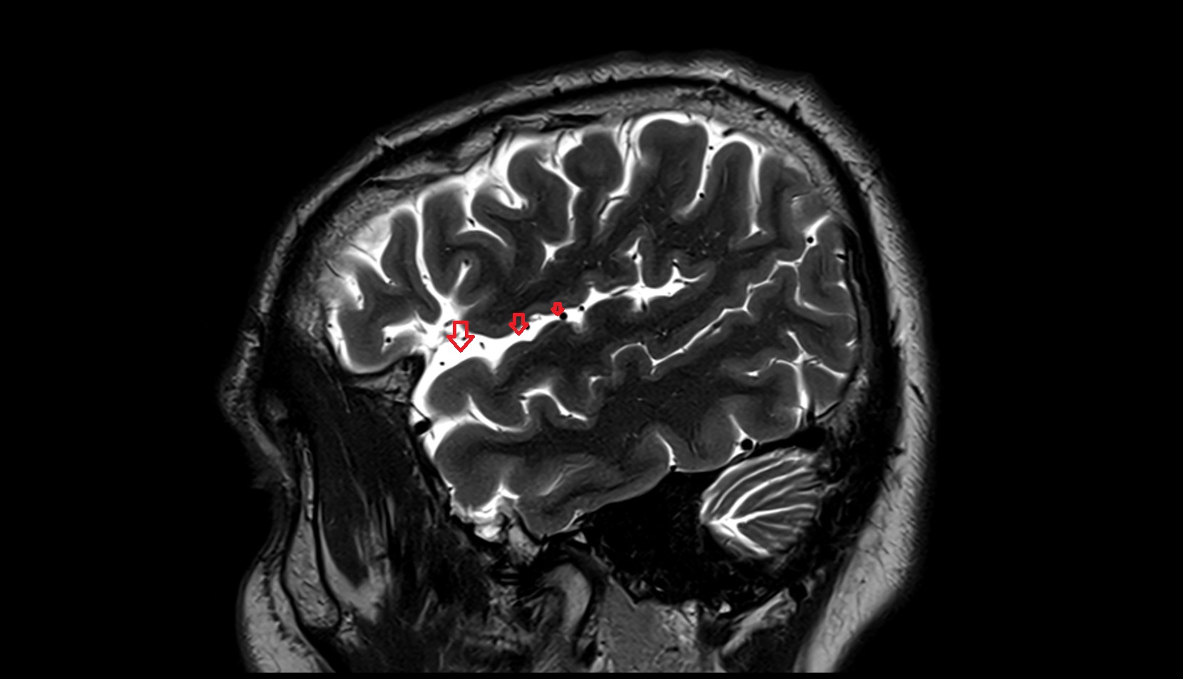 Lateral sulcus (Sylvian fissure) MRI 3T sagittal image