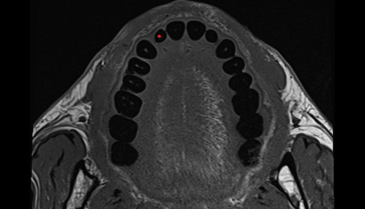 Lateral superior incisor tooth  mri axial  image -img-00000-00000