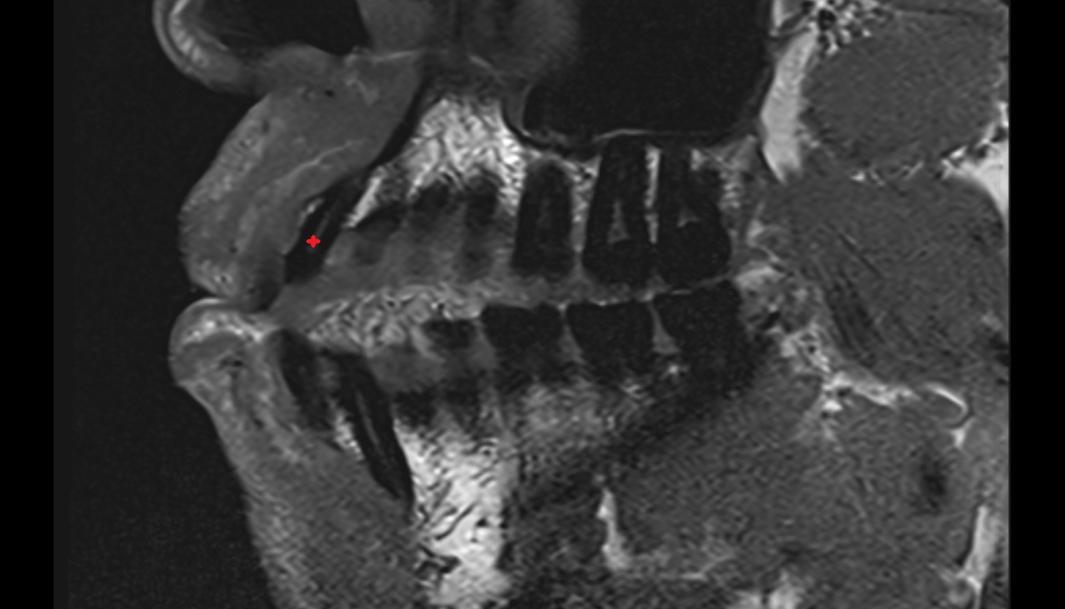 Lateral superior incisor tooth mri sag  image -img-00000-00000