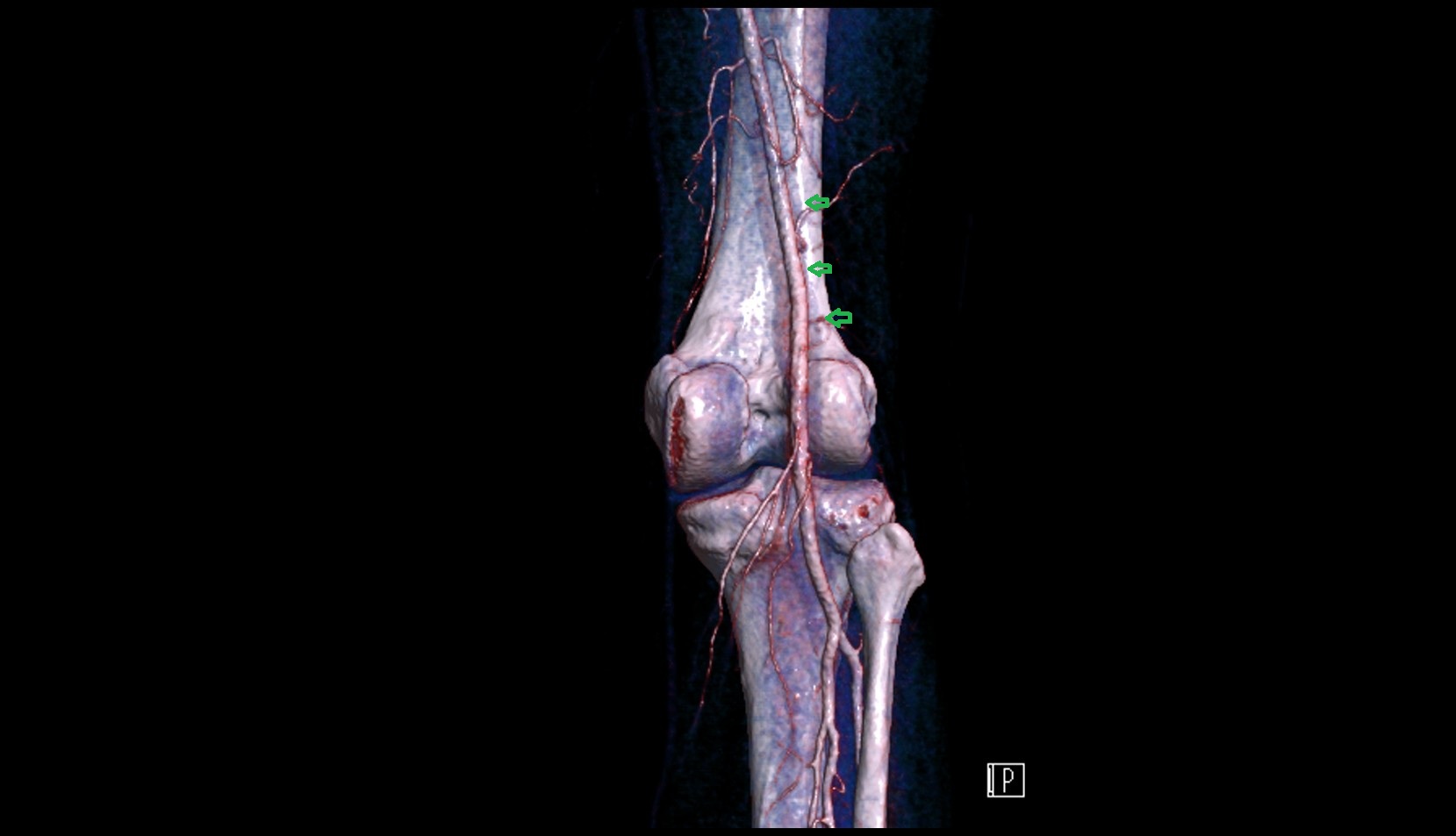 Lateral supracondylar line 3d
