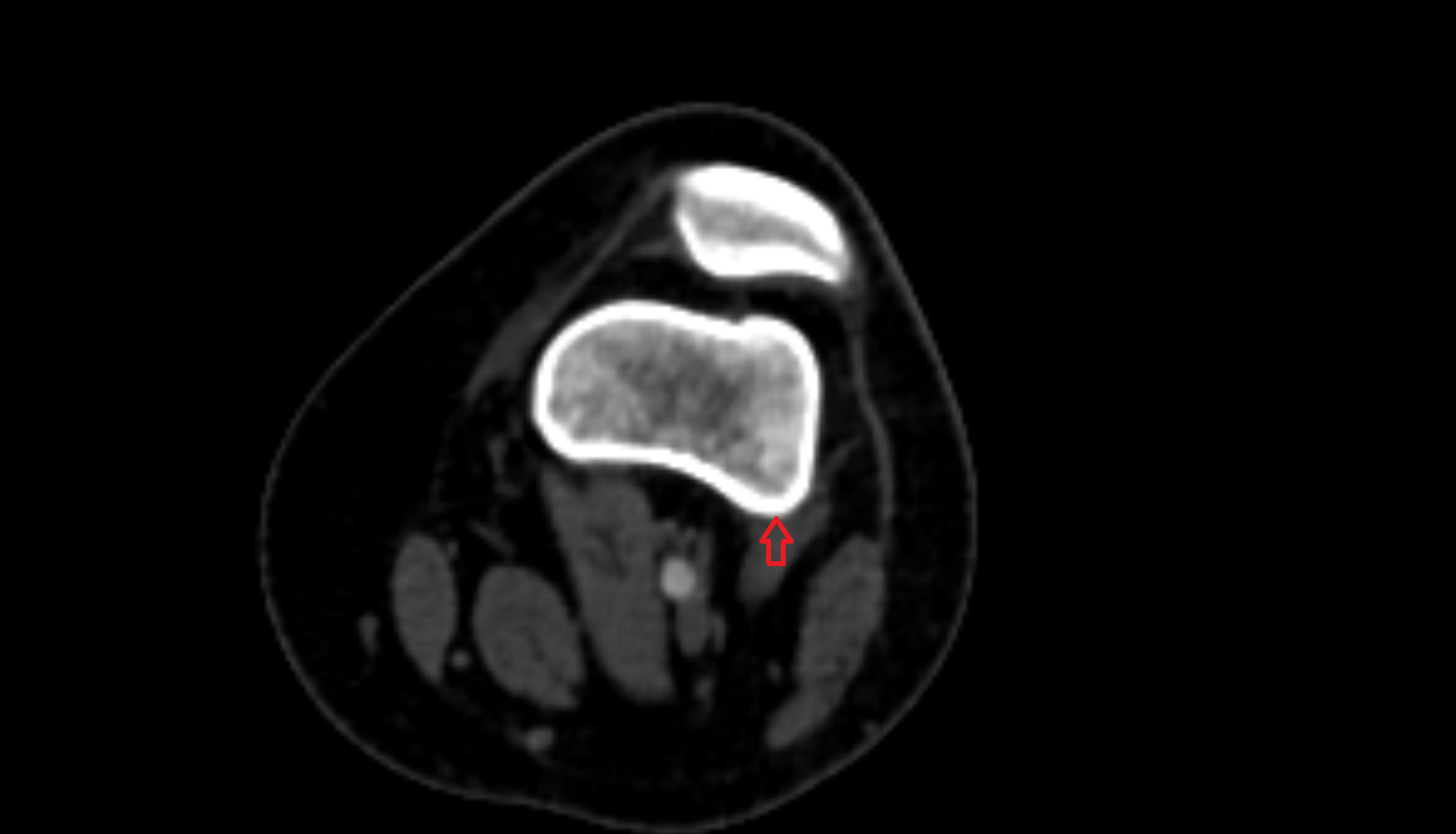 Lateral supracondylar line  ct  anatomy labelled image-img-00000-00000