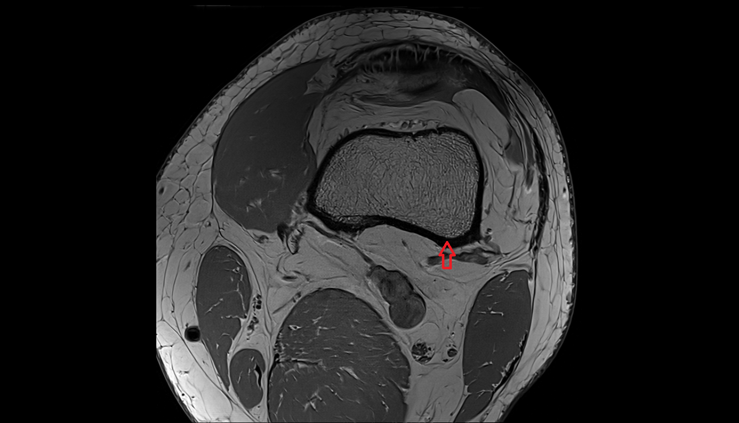 Lateral supracondylar line  mri  anatomy labelled image-img-00000-00000