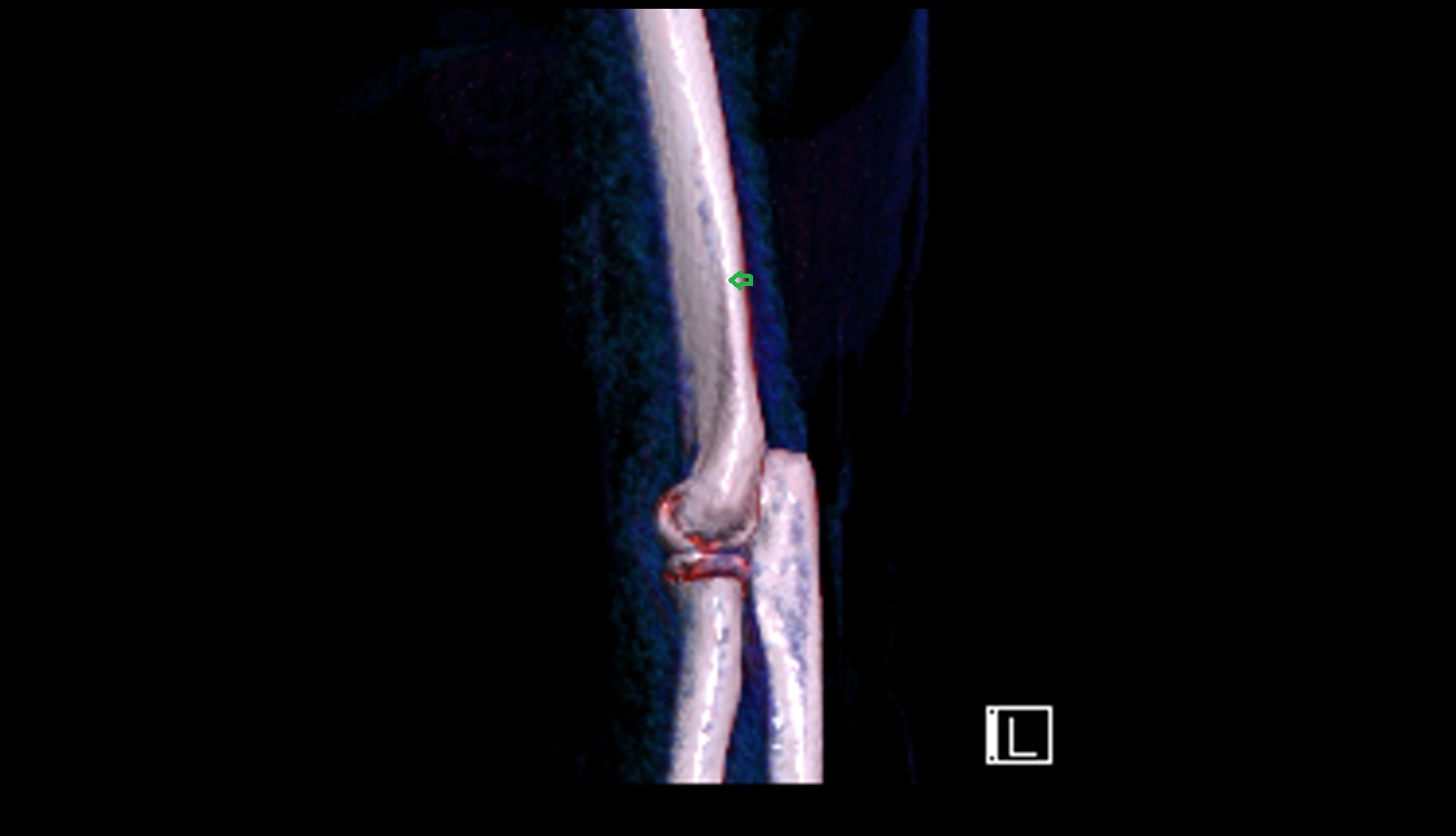 Lateral supracondylar ridge 3D VRT IMAGE
