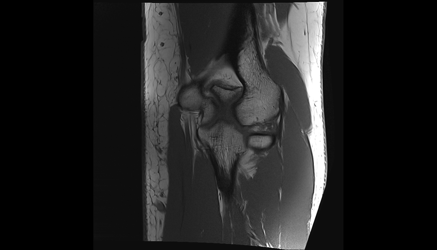 Lateral supracondylar ridge  coronal cross sectional anatomy 3T MRI AI enhanced radiology image -img-00000-00000