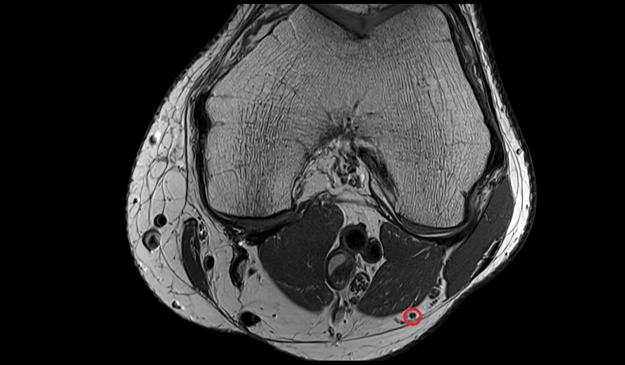 Lateral sural cutaneous nerve