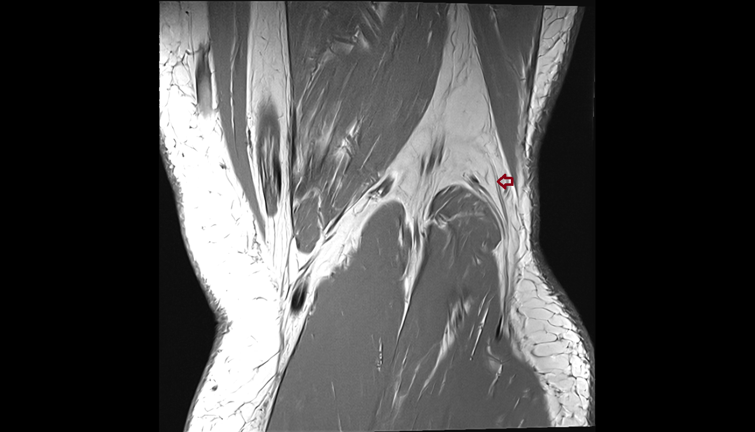 Lateral sural cutaneous nerve coronal  cross sectional anatomy 3T MRI AI enhanced  radiology  anatomy image-img-00000-00000