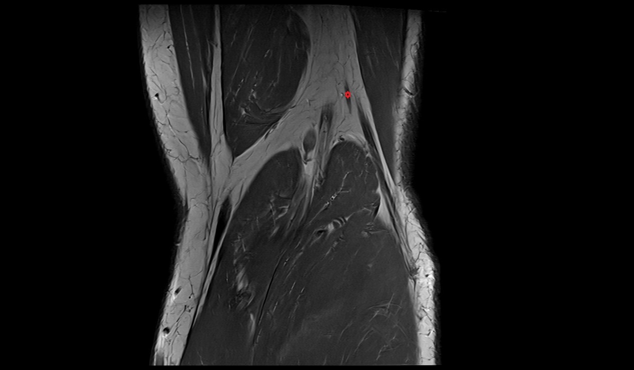 Lateral sural cutaneous nerve mri scan