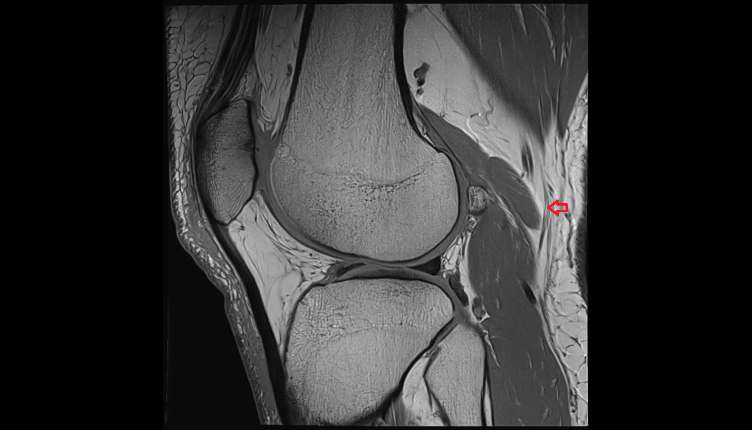 Lateral sural cutaneous nerve sag  cross sectional anatomy 3T MRI AI enhanced  radiology  anatomy image-img-00000-00000