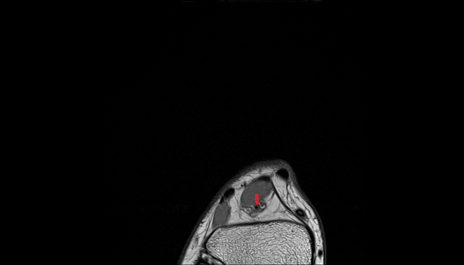 Lateral tarsal artery  axial  cross sectional anatomy 3T MRI AI enhanced radiology image-img-00000-00000