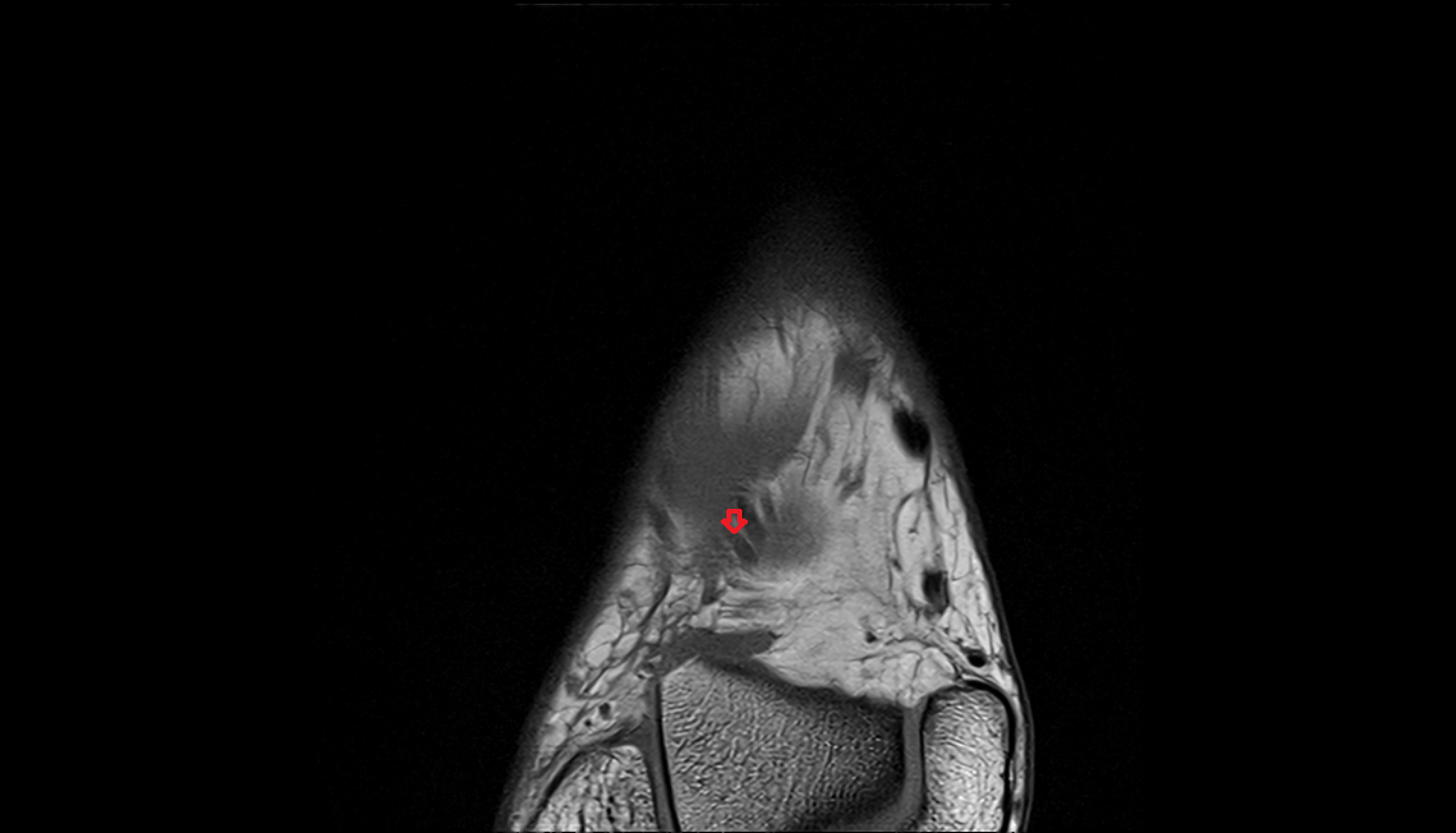 Lateral tarsal artery  axial  cross sectional anatomy 3T MRI AI enhanced radiology image-img-00000-00000_00001