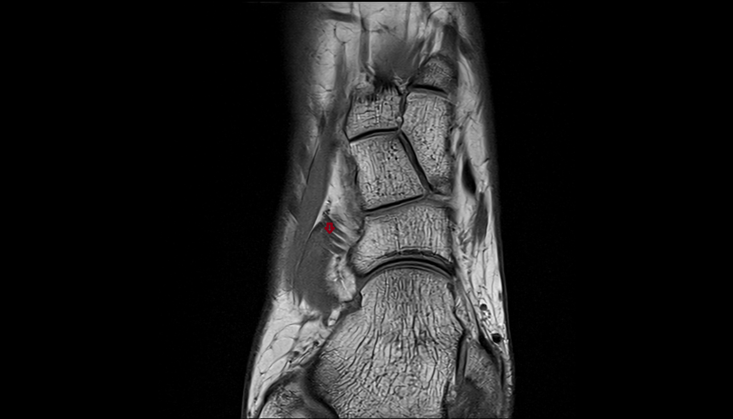 Lateral tarsal artery  axial  cross sectional anatomy 3T MRI AI enhanced radiology image-img-00000-00000_00002