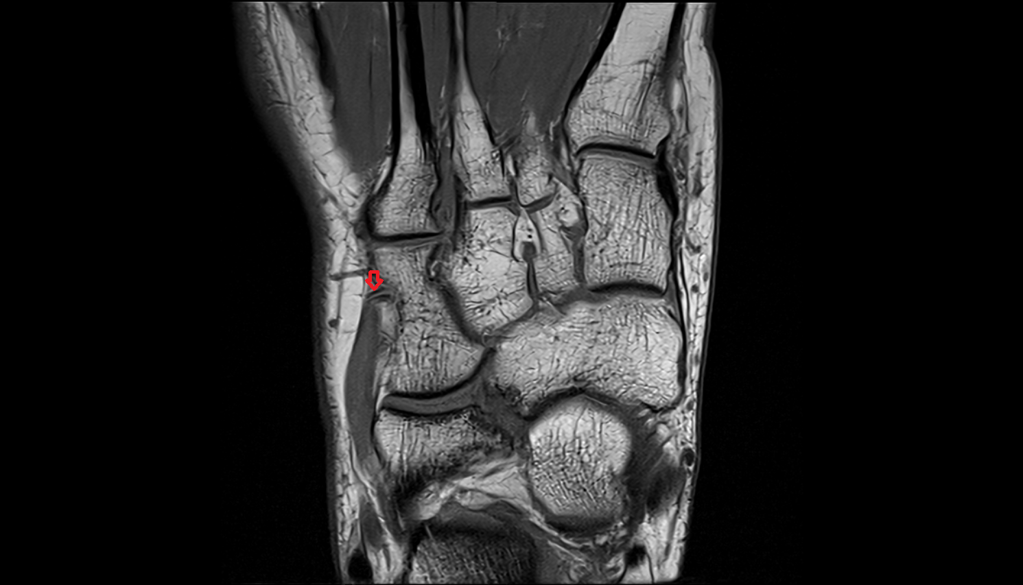 Lateral tarsal artery  axial  cross sectional anatomy 3T MRI AI enhanced radiology image-img-00000-00000_00003