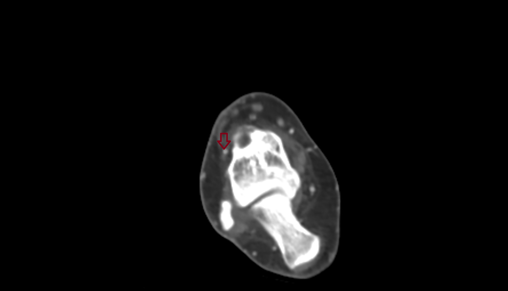 Lateral tarsal artery ct axil 1