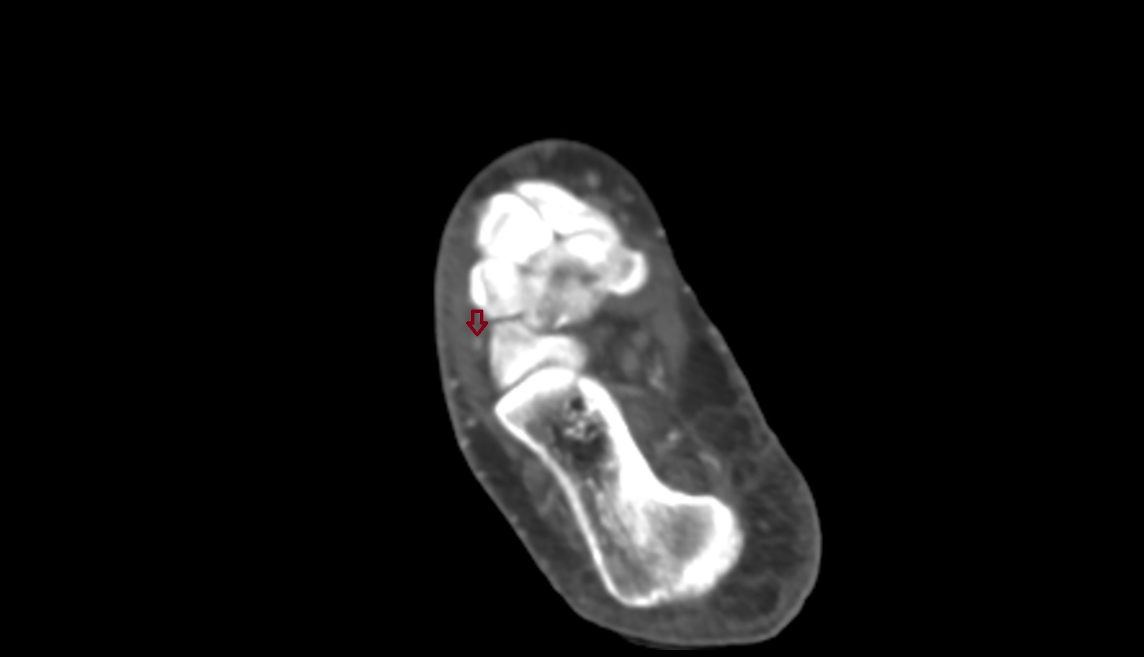 Lateral tarsal artery ct axil 2