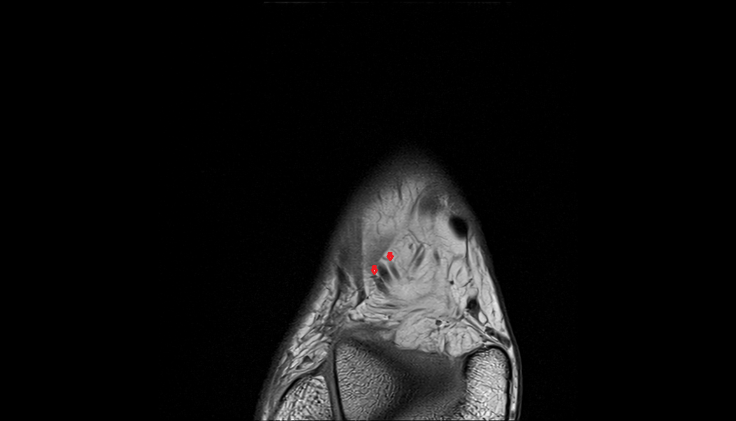 Lateral tarsal veins  axial  cross sectional anatomy 3T MRI AI enhanced radiology image-img-00000-00000