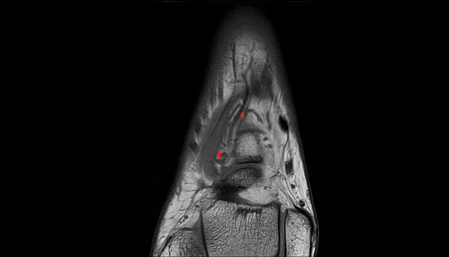 Lateral tarsal veins  axial  cross sectional anatomy 3T MRI AI enhanced radiology image-img-00000-00000_00001