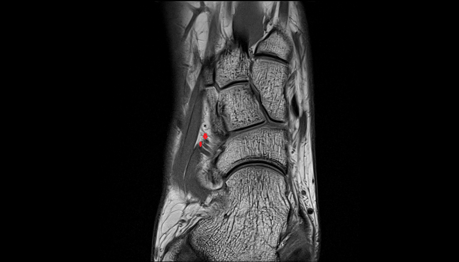 Lateral tarsal veins  axial  cross sectional anatomy 3T MRI AI enhanced radiology image-img-00000-00000_00002