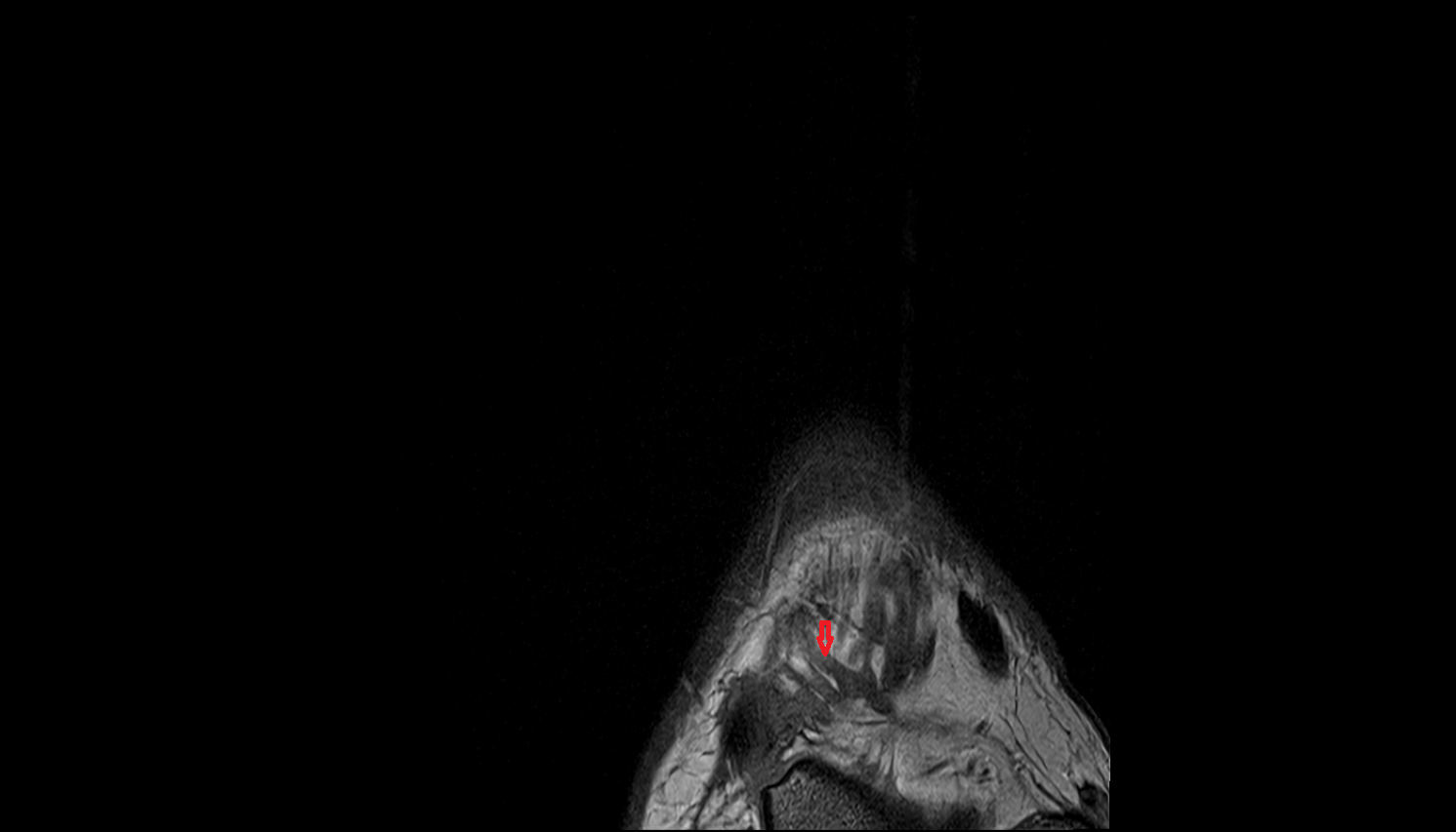 Lateral tarsal veins  of foot coronal cross sectional anatomy 3T MRI AI enhanced radiology image-img-00000-00000