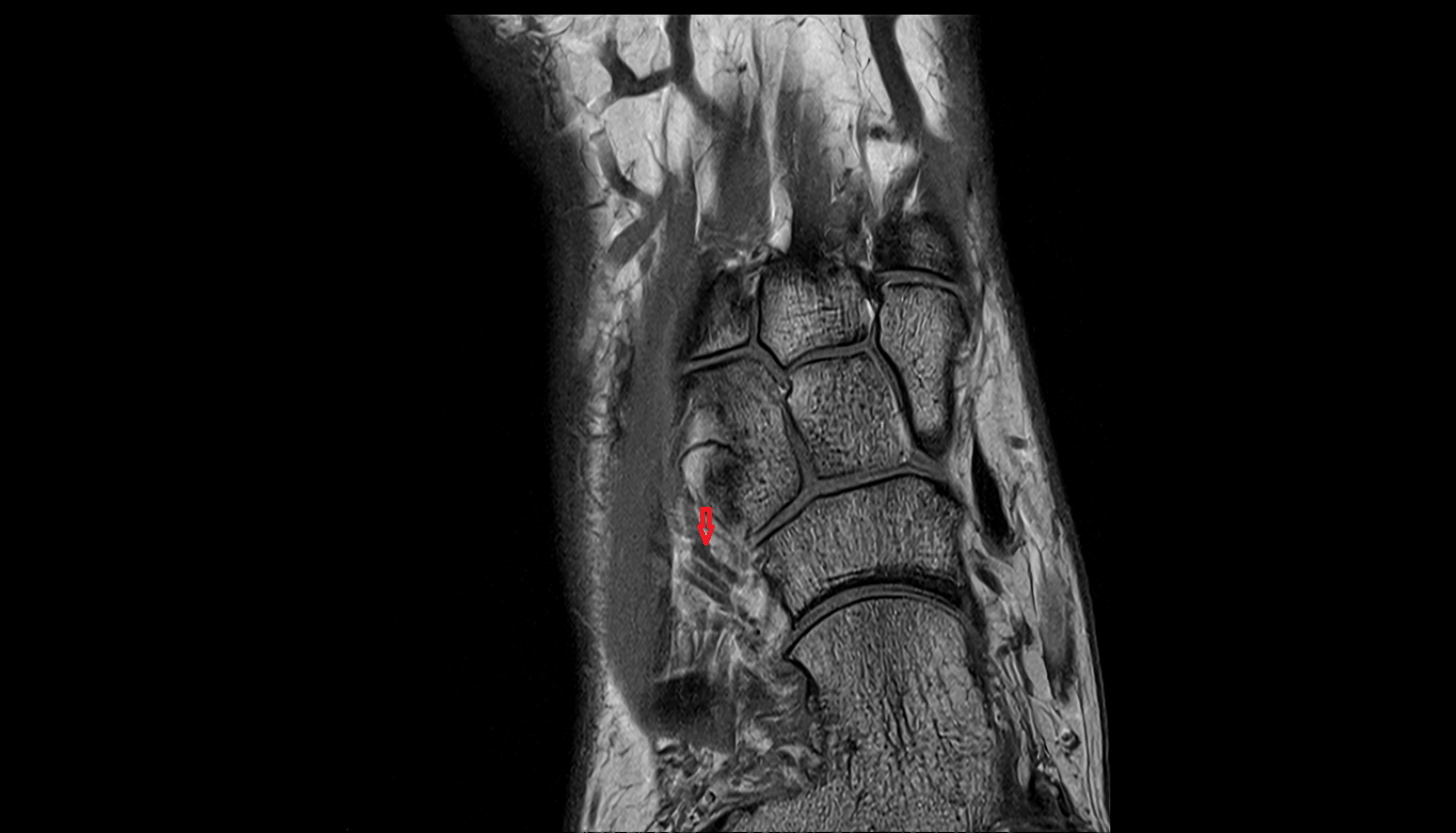 Lateral tarsal veins  of foot coronal cross sectional anatomy 3T MRI AI enhanced radiology image-img-00000-00000_00001