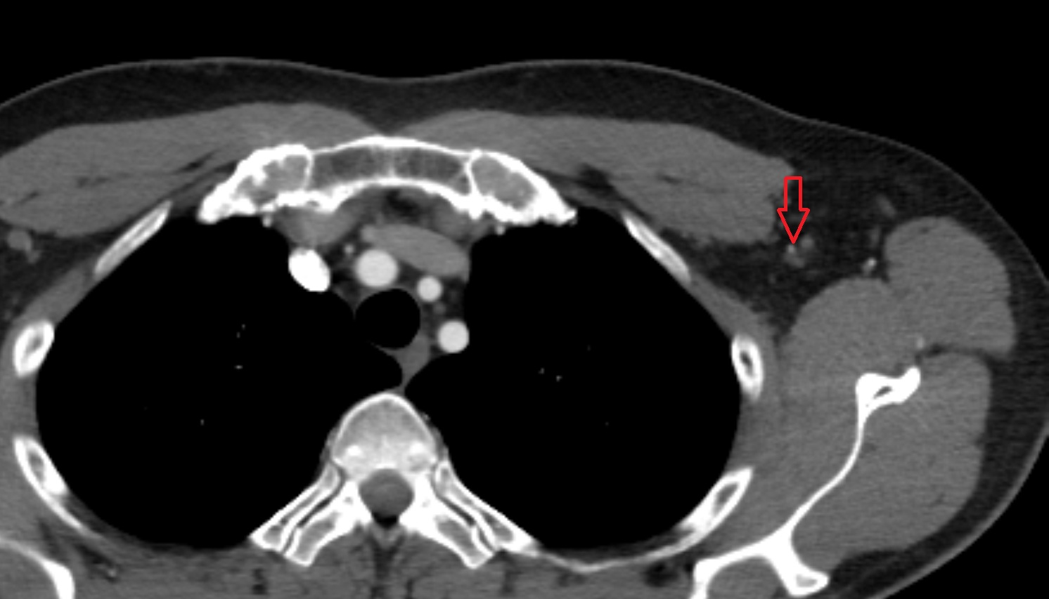 Lateral thoracic artery  anatomy CT axial  image -img-00000-00000