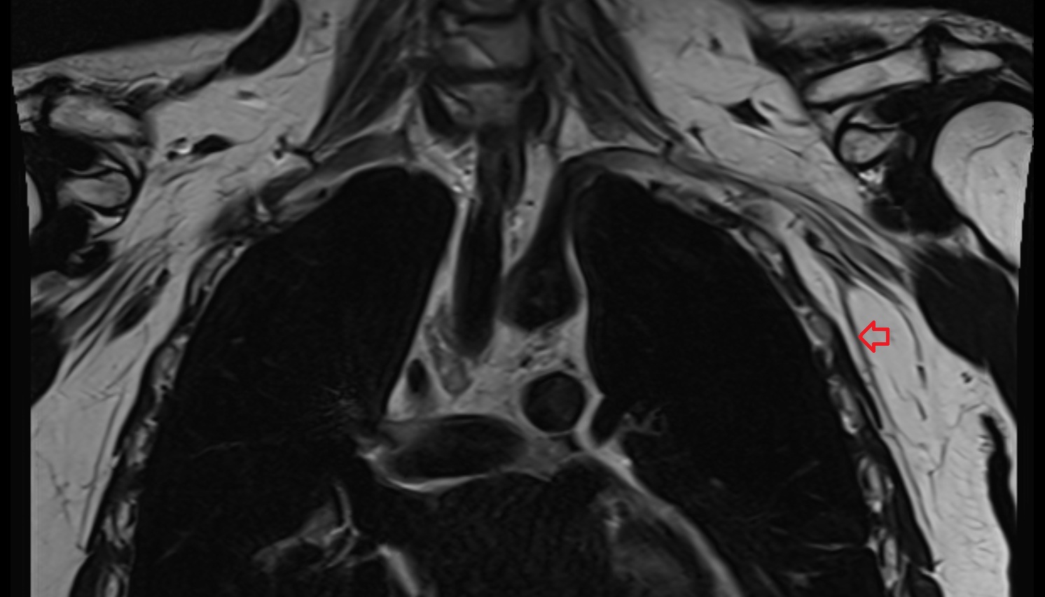 Lateral thoracic artery  anatomy MRI coronal  image -img-00000-00000