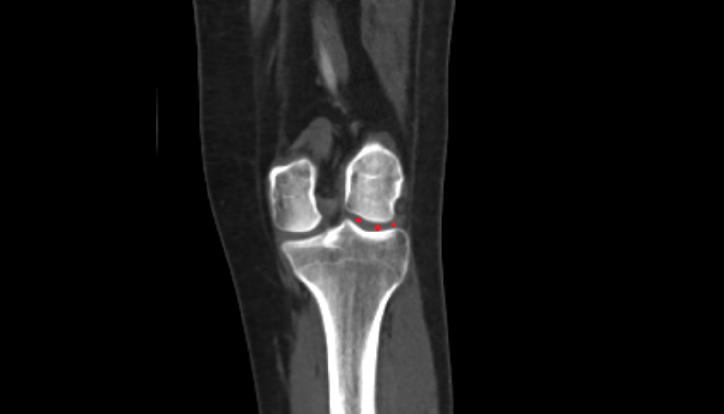Lateral tibiofemoral joint space  ct  anatomy labelled image-img-00000-00000