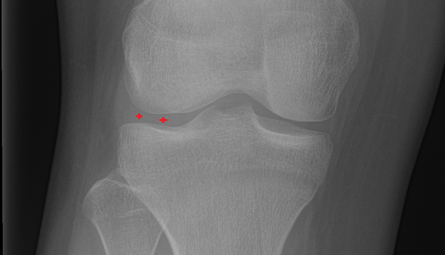 Lateral tibiofemoral joint space  x ray  anatomy labelled image-img-00000-00000