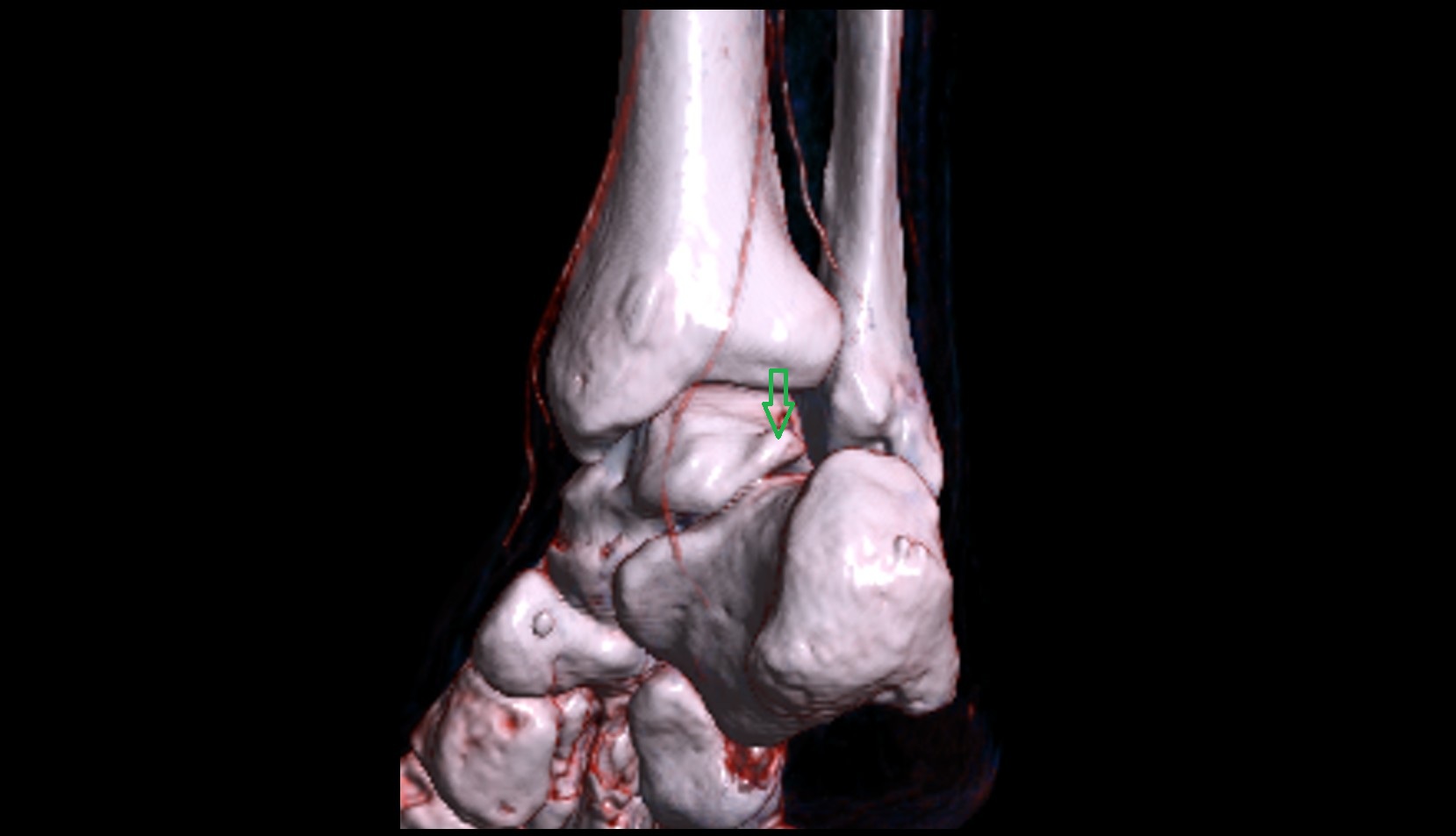 Lateral tubercle of talus 3d