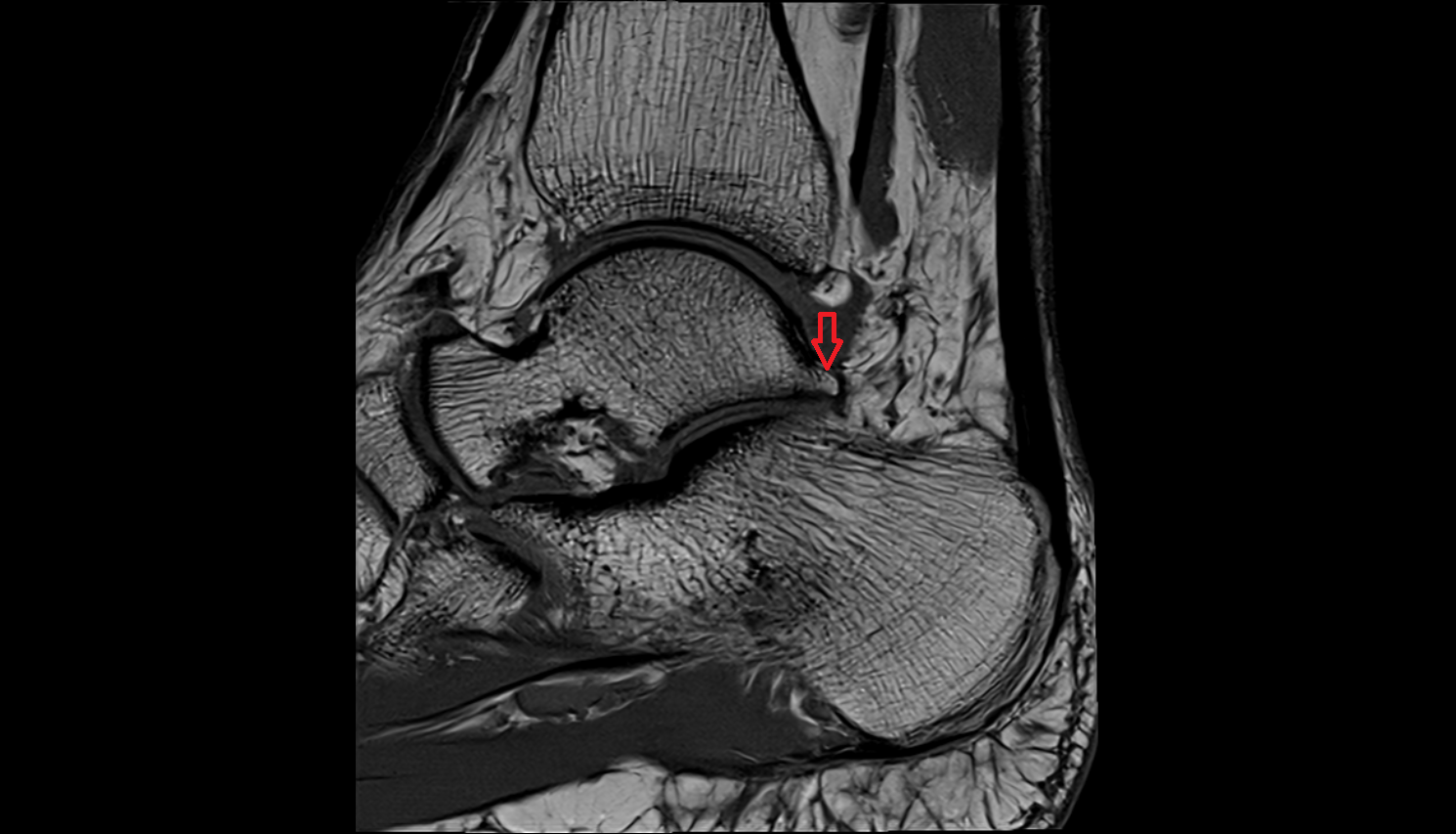 Lateral tubercle of talus  mri  anatomy labelled image-img-00000-00000