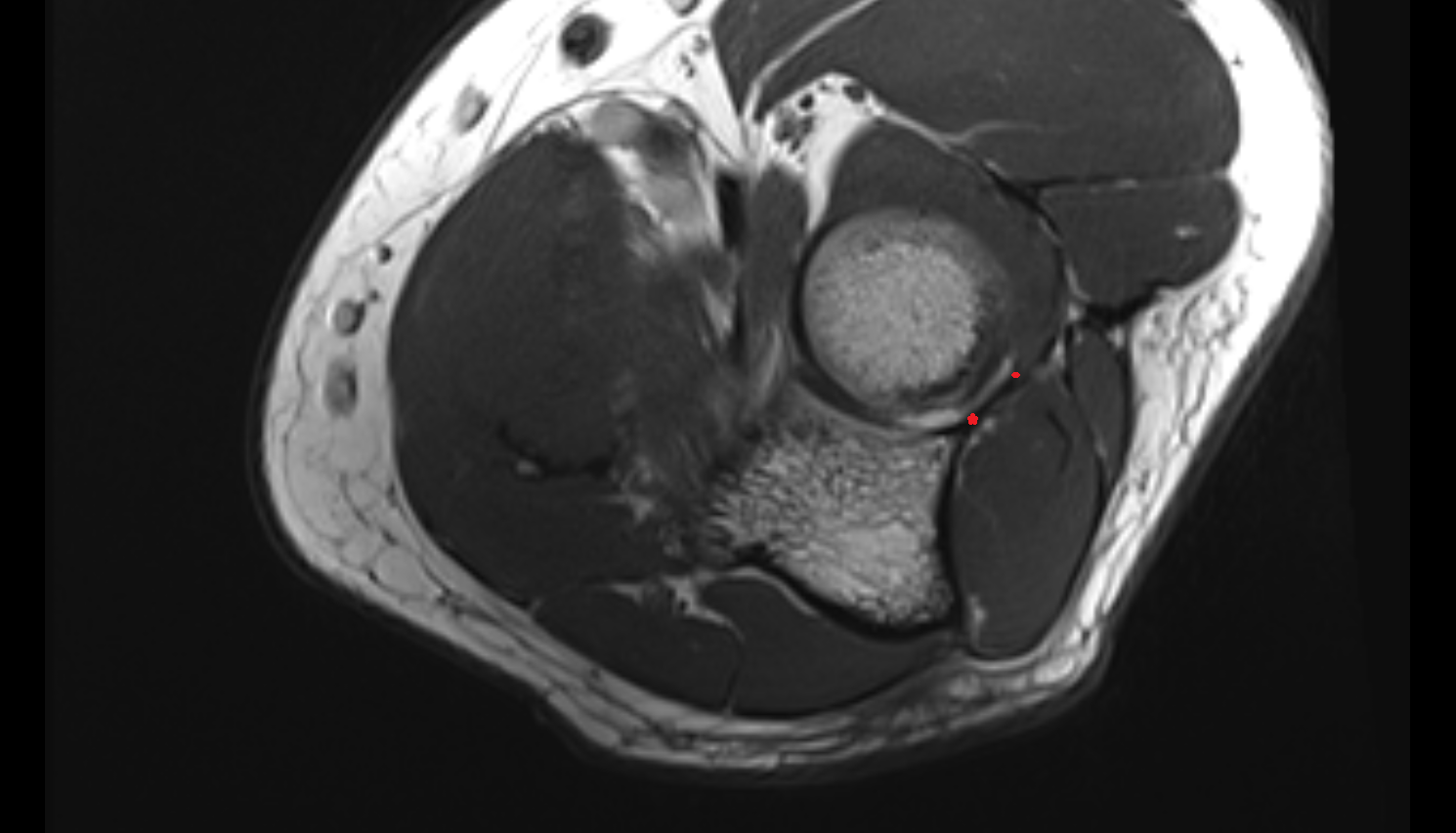 Lateral ulnar collateral ligament axial cross sectional anatomy 3T MRI AI enhanced radiology image -img-00000-00000_00001