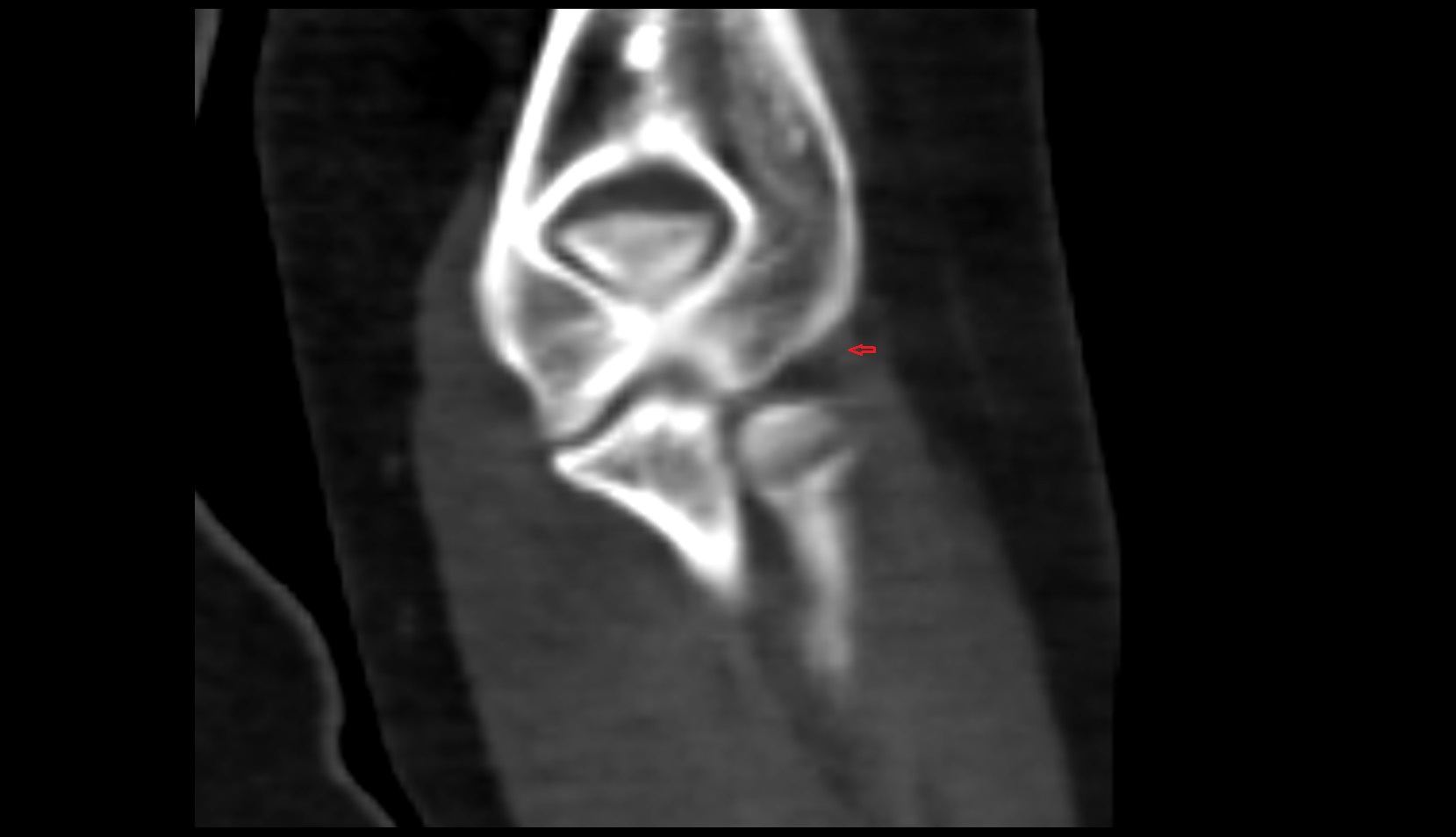 Lateral ulnar collateral ligament ct coronal
